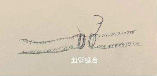 市二院急诊科“断指再植术” 让离断小指重获新生870.png