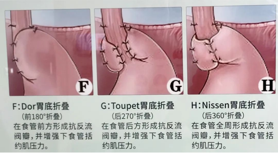 老太反复咳嗽、呕吐5年，原因竟是“食管裂孔疝”！市二院普外二科腹腔镜微创手术速解难题1220.png