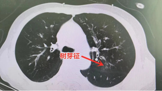 “哮喘”多年，终于揪出真正元凶！市二院呼吸内科成功诊治一例ABPA患者546.png