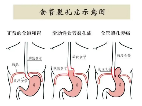 老太反复咳嗽、呕吐5年，原因竟是“食管裂孔疝”！市二院普外二科腹腔镜微创手术速解难题1737.png